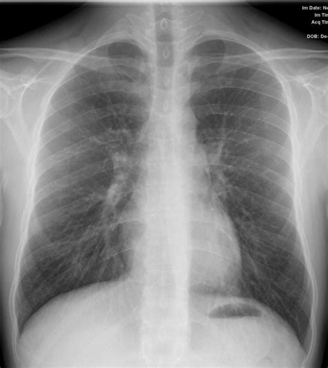 034Lu Basal Bronchitis Bronchiectasis Young Female | Lungs