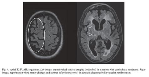 Irresti: Corticobasal Degeneration Mri Radiopaedia