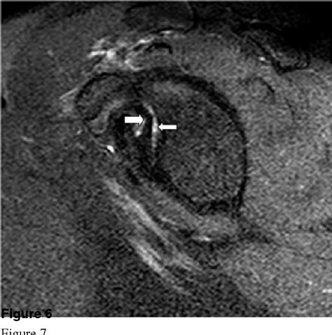 Normal variants of the middle glenohumeral ligament in MR imaging of ...