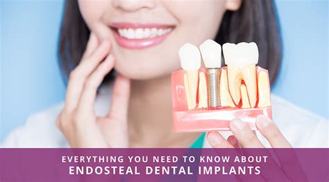 Everything You Need to Know About Endosteal Dental Implants ...