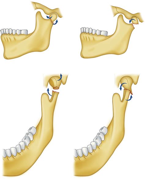 Condylar Neck Fracture