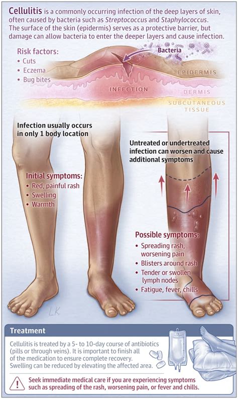 Skin Disorder 101: What is Cellulitis? | Symptoms, Causes, Risks ...