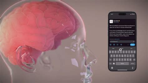 Musk says first Neuralink patient can control mouse with thoughts ...