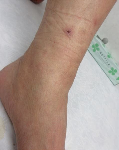 Figure 5. A typical eschar at left leg of the patient : A Case of Scrub Typhus with Multiple ...