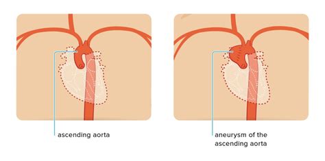 stigande aortaaneurysm