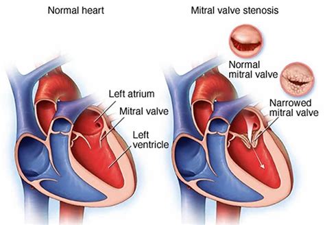 Pathophysiology Of Mitral Valve