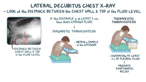 Pleural effusion: Clinical: Video, Anatomy & Definition | Osmosis