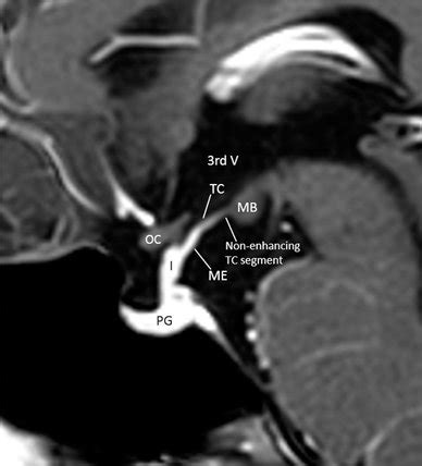 Postcontrast midsagittal magnetic resonance image of a patient showing ...