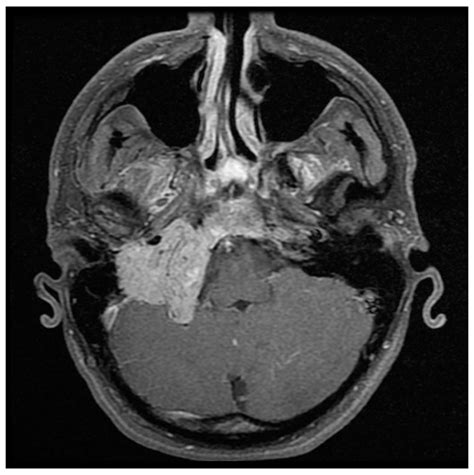 Glomus Jugulare Tumor