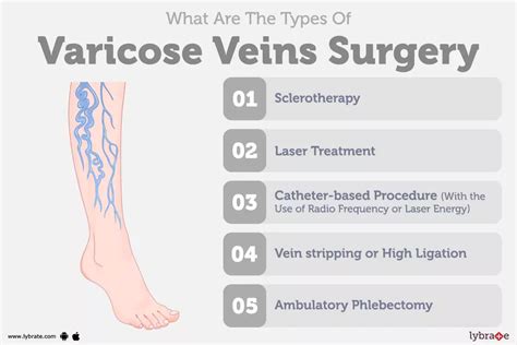 Varicose Veins Surgery: Purpose, Procedure, Benefits and Side Effects