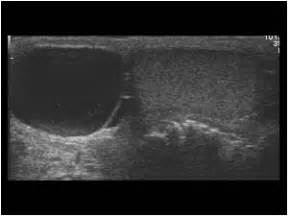 Urinary Tract and male reproductive system | 2.3 Scrotum : Case 2.3.2 ...