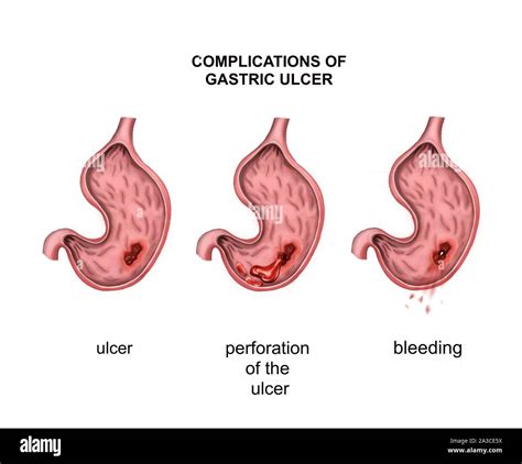 Oncology. Ulcer. Complications: perforation and bleeding Stock Photo ...