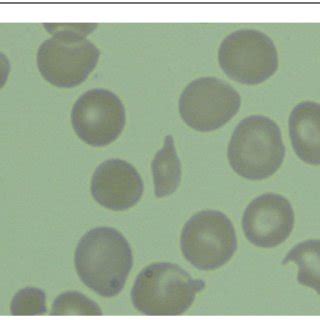 Peripheral blood smear with schitocytosis. | Download Scientific Diagram