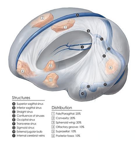 Olfactory Groove Meningioma | The Neurosurgical Atlas, by Aaron Cohen ...