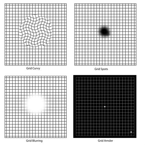 Degeneração macular - tipos, causas, tratamento - InfoEscola