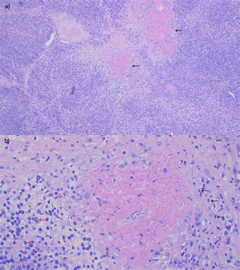 Cureus | A Rare Case of Adrenal Carcinoma With Isolated Hypercortisolism Mimicking ...