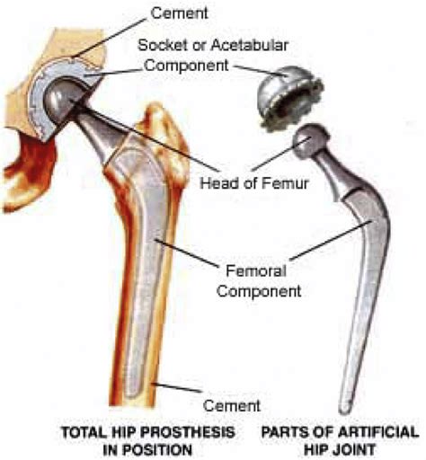 Main components in the structure of an artificial hip joint [29 ...