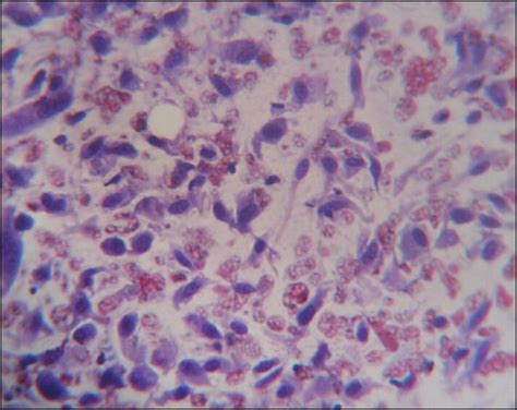 Cytology of malignant spindle cell tumor ×400 | Download Scientific Diagram