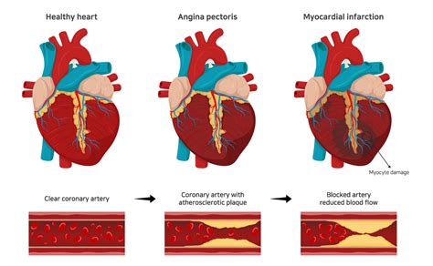 Heart Disease, Hypertension, High Blood Cholesterol - Heart Disease