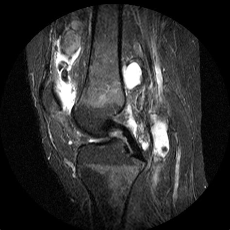 Pigmented villonodular synovitis (PVNS) | Image | Radiopaedia.org