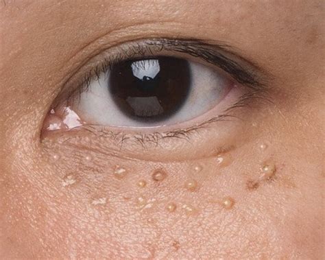 What Causes Milia on Face, How to Remove and Treat?