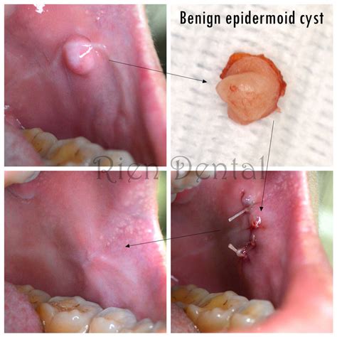 Epidermoid cyst in cheek.