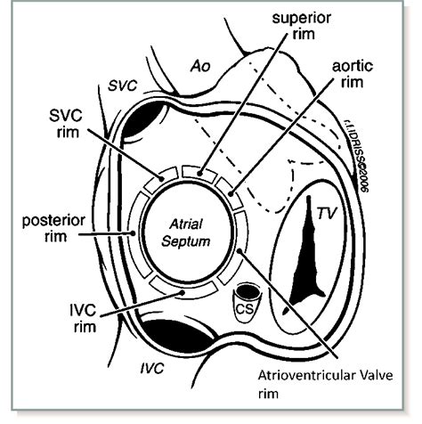 Rims of the atrial septum as seen from the right atrium. Ao indicates... | Download Scientific ...