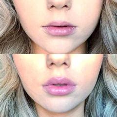 Do Lip Plumpers Actually work? – Plump it!