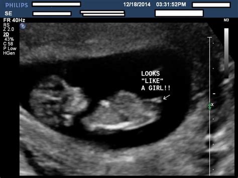 Comfirmed girl ultrasound pic at 12 weeks - BabyCenter