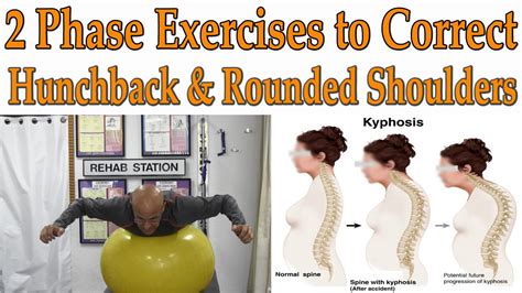 2 Phase Exercises to Correct Hunchback, Kyphosis, Rounded Shoulders - Dr Mandell - YouTube