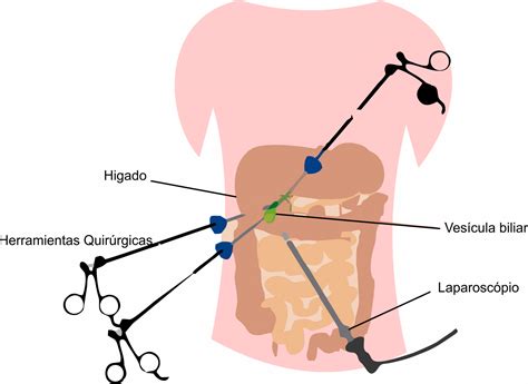 colecistectomia - Dr. Jorge Blanco. Cirujano Bariatra