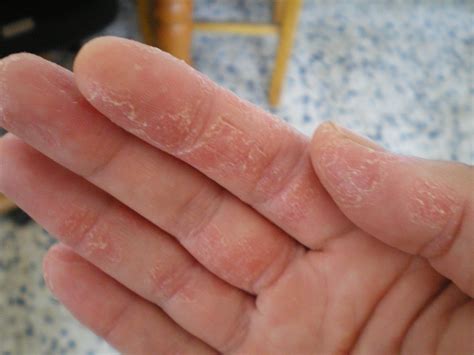 Pin oleh Ellary Heinold di All About Eczema | Kesehatan, Obat herbal ...