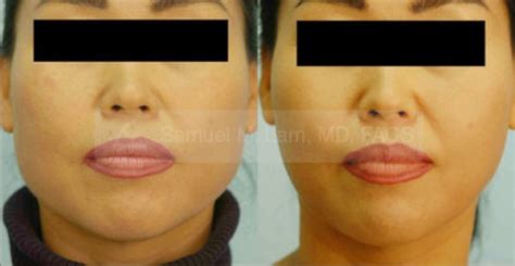 Dallas Botox Jaw Reduction Before and After Photos - Plano Plastic ...