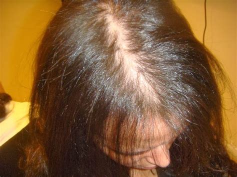 Treatment For Female Pattern Baldness (Options That Work ...