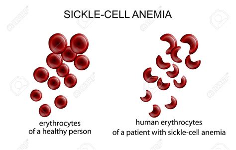 Sickle Cell Anemia