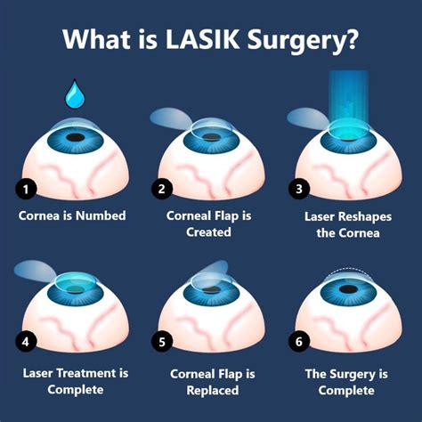 How Much For Lasik Eye Surgery 2025 - Bess Lorelle