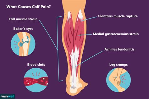 7 Common Causes of Calf Pain and How to Treat Them