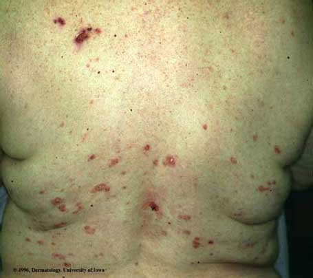 Pemphigus Foliaceus | Department of Dermatology