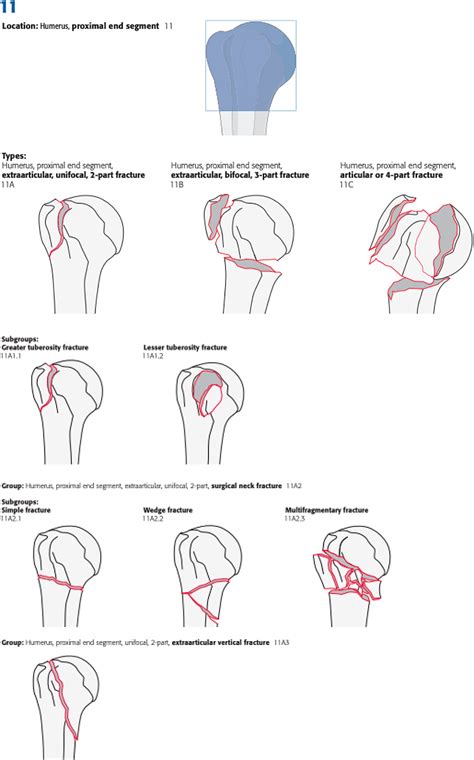 Mechanisms Of Humeral Head Fracture