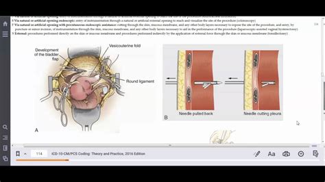 HIT 208 Port-a-Cath Removal External vs Open Approach Explained - YouTube