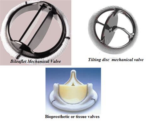 Type of Artificial Heart Valves | Cardiac Surgery in Delhi | Dr S K Sinha