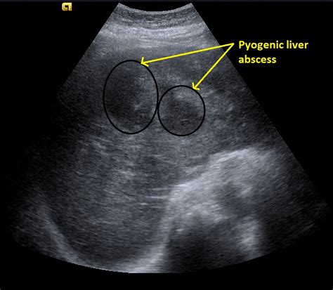 Pyogenic liver abscess ultrasound - wikidoc