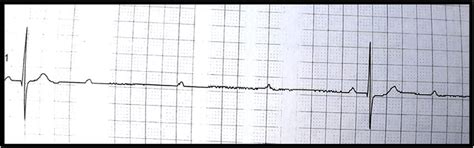 A 4.2-s high-grade AV block induced by left-sided carotid sinus massage. | Download Scientific ...