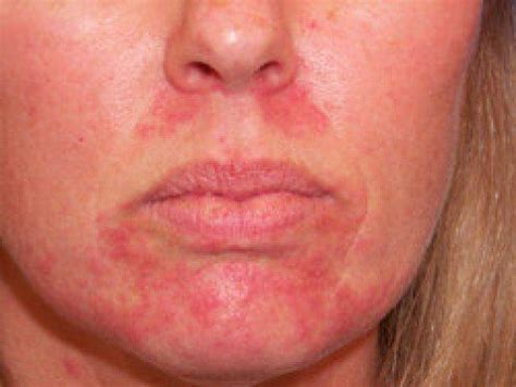 Facial Rash: Causes and Treatment | New Health Advisor