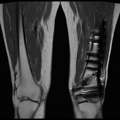 Metal \Titanium Artifact MRI | Magnetic Susceptibility Artifact MRI