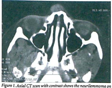 Figure 1 from Neurilemmoma Presenting as a Midline Nasal Mass in a ...