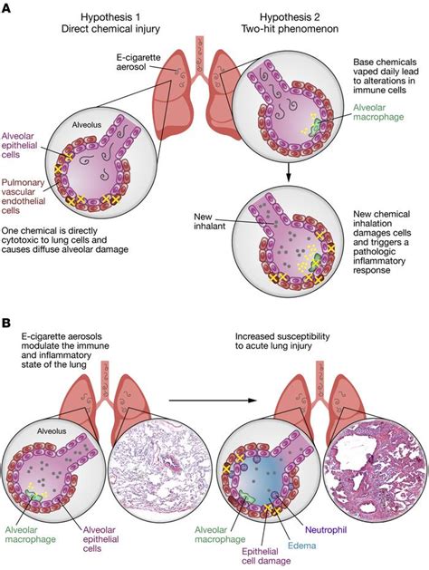 JCI - What are the mechanisms underlying vaping-induced lung injury?