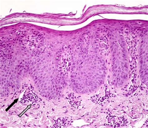 Histology of psoriasis. Staining of a psoriasis tissue section by... | Download Scientific Diagram