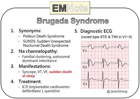 EMNote.org - Brugada Syndrome This is an ECG abnormality... | Facebook