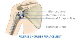 cost of shoulder replacement surgery 2020 - regulafaruolo